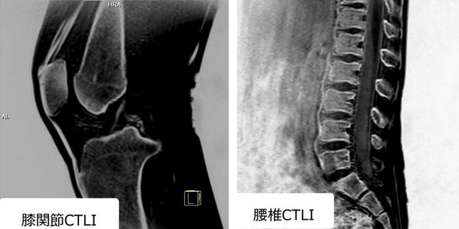 膝関節CTLI / 腰椎CTLI