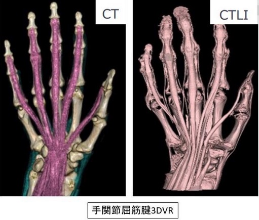 腰椎分離症