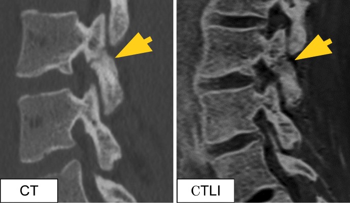 腰椎分離症CT/CTLI