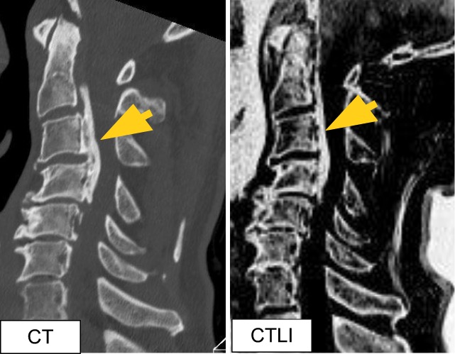 後縦靭帯骨化症（OPLL）CT/CTLI